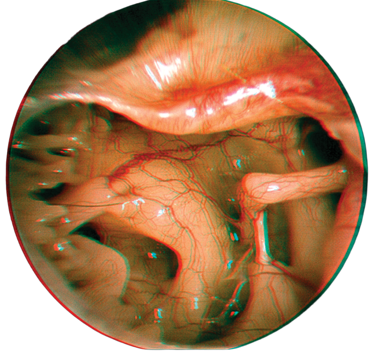 ApoClear Optic Technology - Before